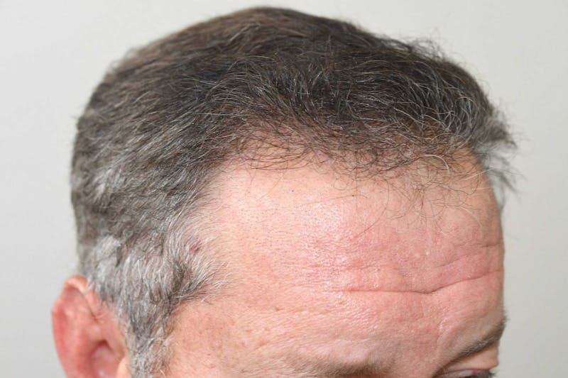 Hair Restoration for Men Before & After Gallery - Patient 368593 - Image 6
