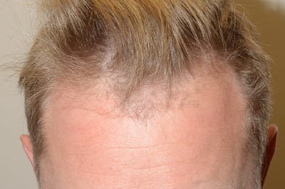 Hair Restoration for Men Before & After Gallery - Patient 315711 - Image 1