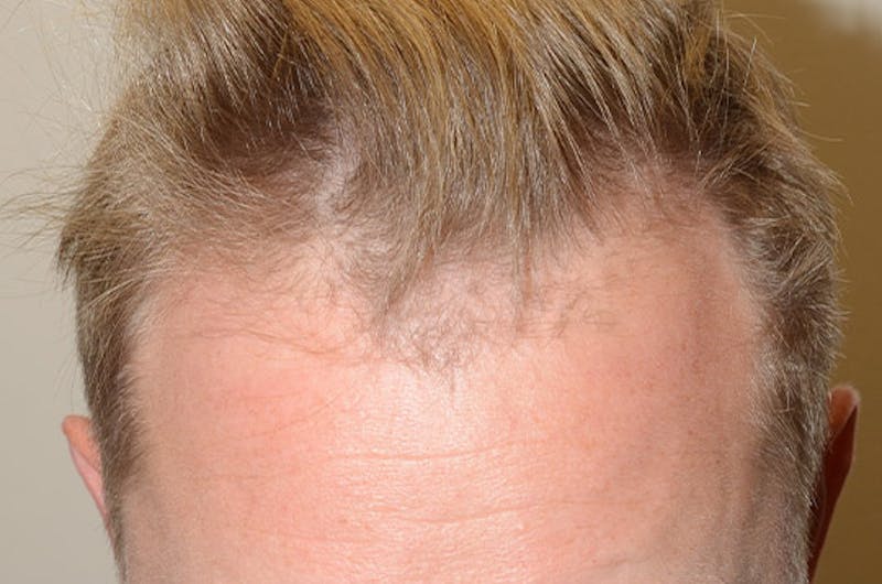 Hair Restoration for Men Before & After Gallery - Patient 399070 - Image 1
