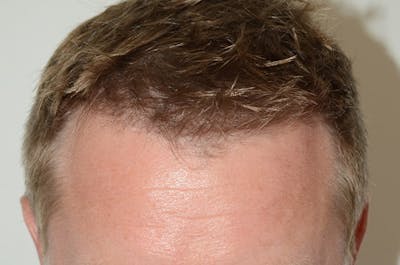 Hair Restoration for Men Before & After Gallery - Patient 315711 - Image 2