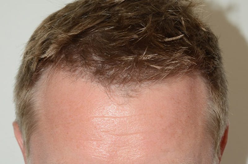 Hair Restoration for Men Before & After Gallery - Patient 399070 - Image 2