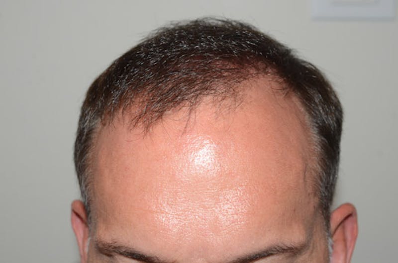 Hair Restoration for Men Before & After Gallery - Patient 118330 - Image 2