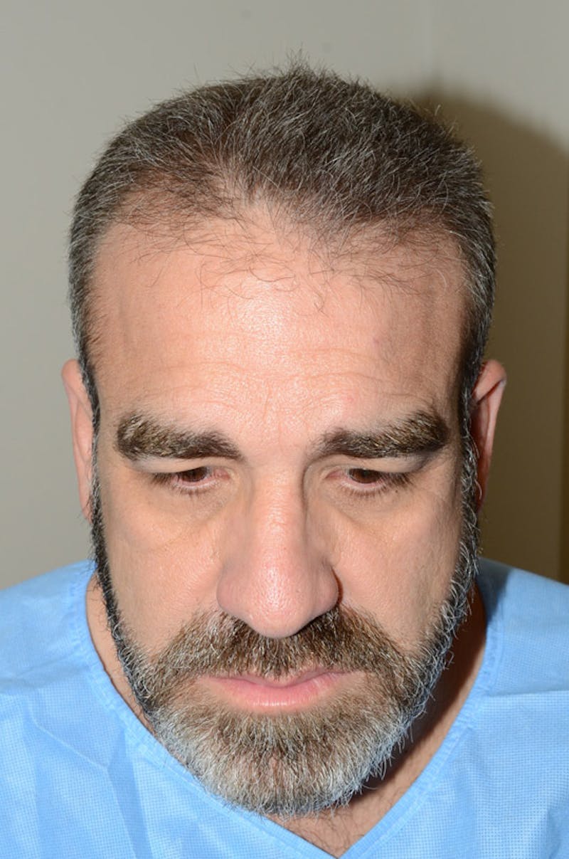 Hair Restoration for Men Before & After Gallery - Patient 105497 - Image 1