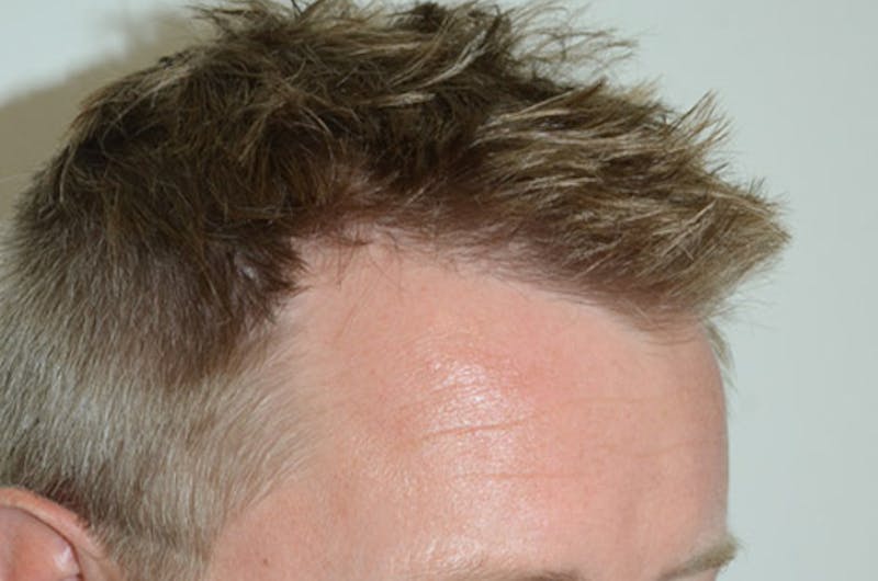 Hair Restoration for Men Before & After Gallery - Patient 399070 - Image 4