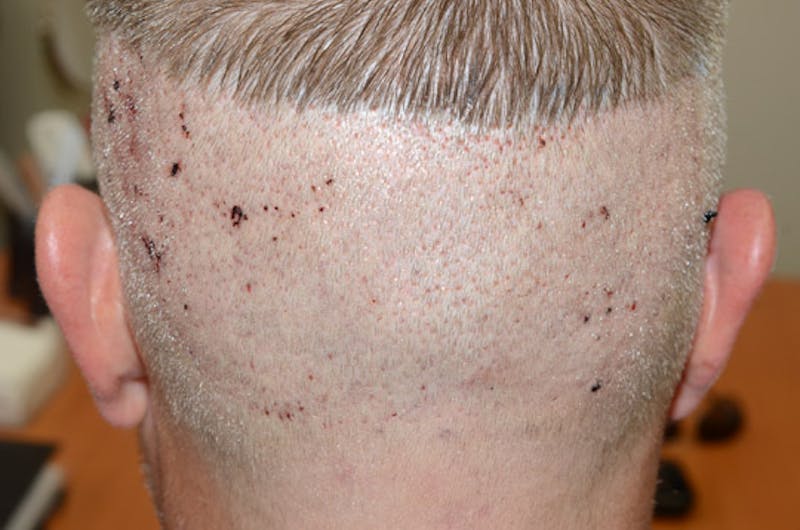 Hair Restoration for Men Before & After Gallery - Patient 399070 - Image 5