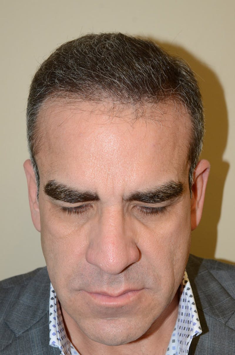 Hair Restoration for Men Before & After Gallery - Patient 105497 - Image 2
