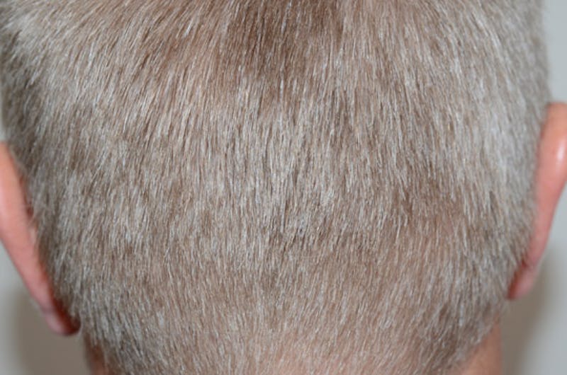 Hair Restoration for Men Before & After Gallery - Patient 399070 - Image 6
