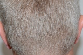 Hair Transplant Repair Before & After Gallery - Patient 469808 - Image 6