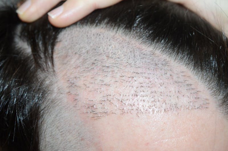 Hair Restoration for Men Before & After Gallery - Patient 258597 - Image 1