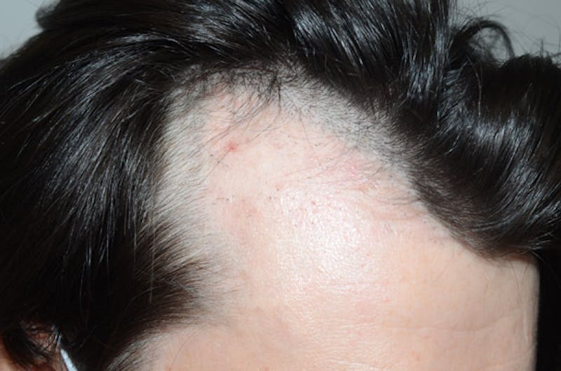 Hair Restoration for Men Before & After Gallery - Patient 258597 - Image 2