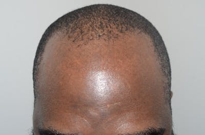 Hair Restoration for Men Before & After Gallery - Patient 416387 - Image 1