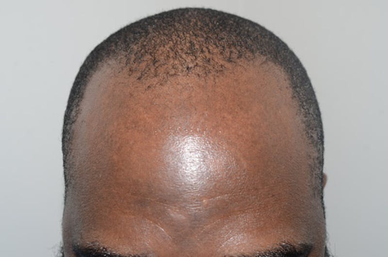 Hair Transplant Repair Before & After Gallery - Patient 160712 - Image 1