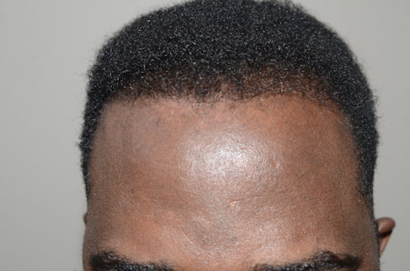 Hair Transplant Repair Before & After Gallery - Patient 160712 - Image 2