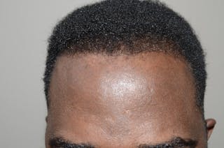 Hair Restoration for Men Before & After Gallery - Patient 998151 - Image 2