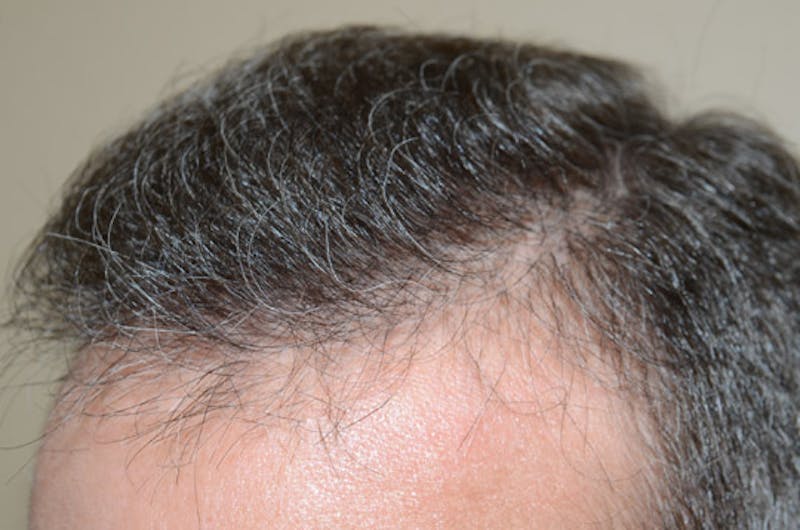 Hair Restoration for Men Before & After Gallery - Patient 105497 - Image 8