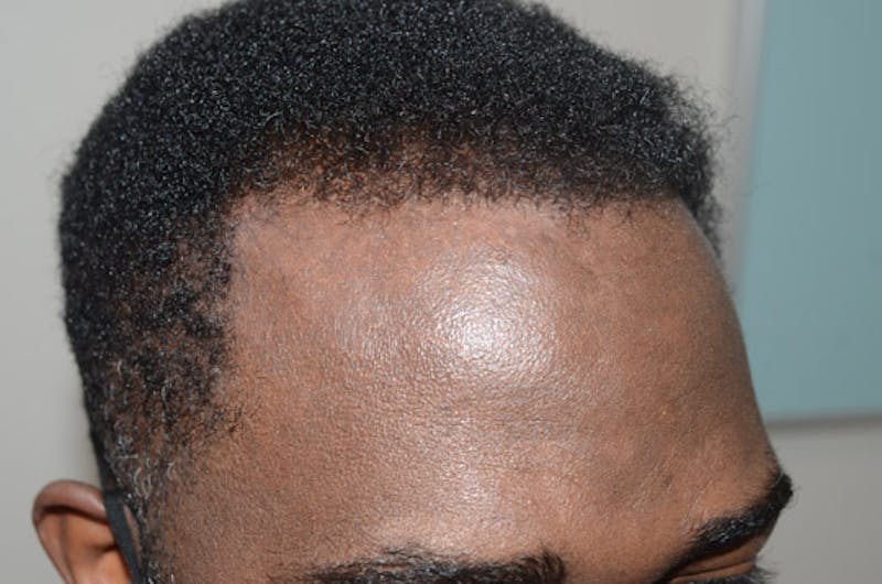 Hair Transplant Repair Before & After Gallery - Patient 160712 - Image 4