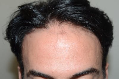Hair Restoration for Men Before & After Gallery - Patient 396439 - Image 1