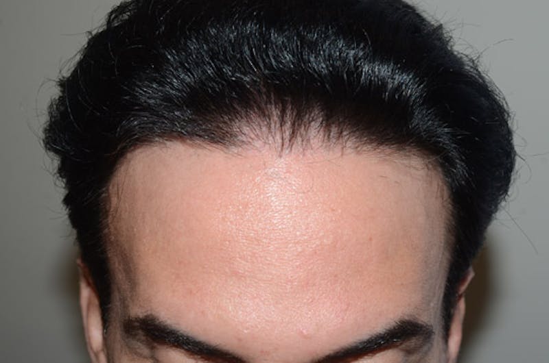 Hair Restoration for Men Before & After Gallery - Patient 400443 - Image 2