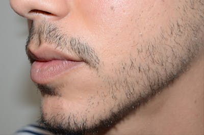Facial Hair Transplant Before & After Gallery - Patient 268498 - Image 2