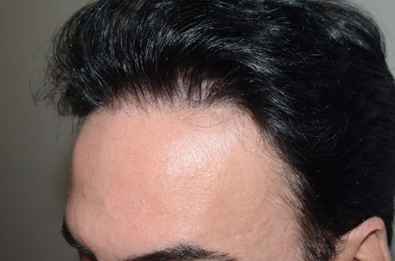 Hair Restoration for Men Before & After Gallery - Patient 400443 - Image 4