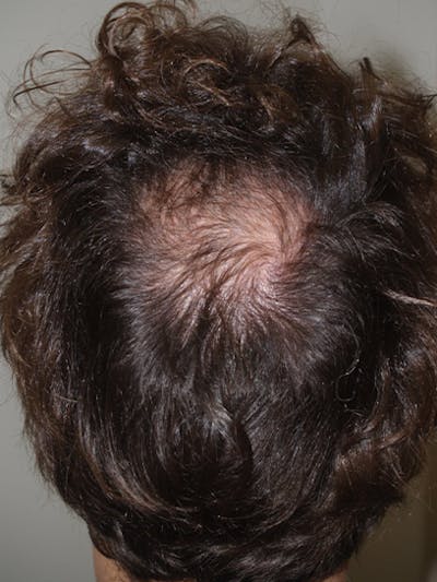 Hair Restoration for Men Before & After Gallery - Patient 419271 - Image 1