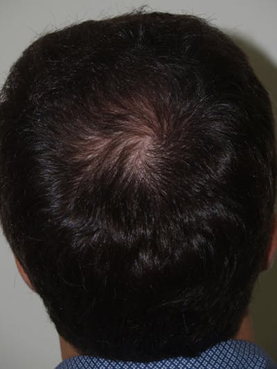 Hair Restoration for Men Before & After Gallery - Patient 419271 - Image 2