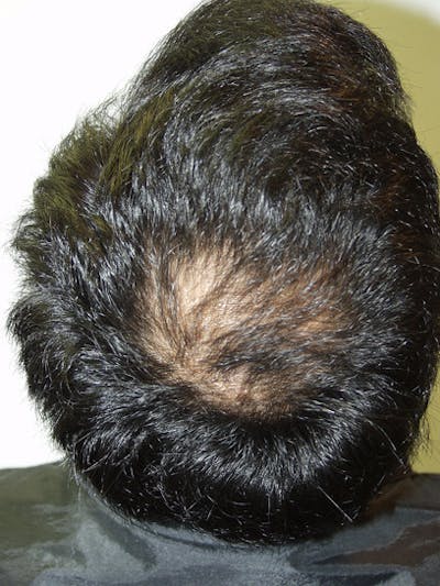 Hair Restoration for Men Before & After Gallery - Patient 224690 - Image 1