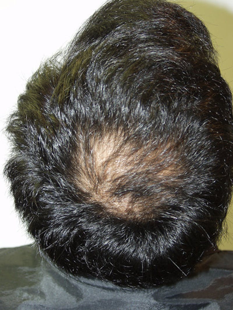 Hair Restoration for Men Before & After Gallery - Patient 404555 - Image 1