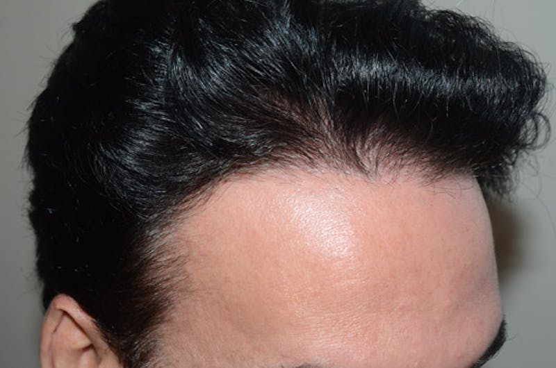 Hair Restoration for Men Before & After Gallery - Patient 400443 - Image 6