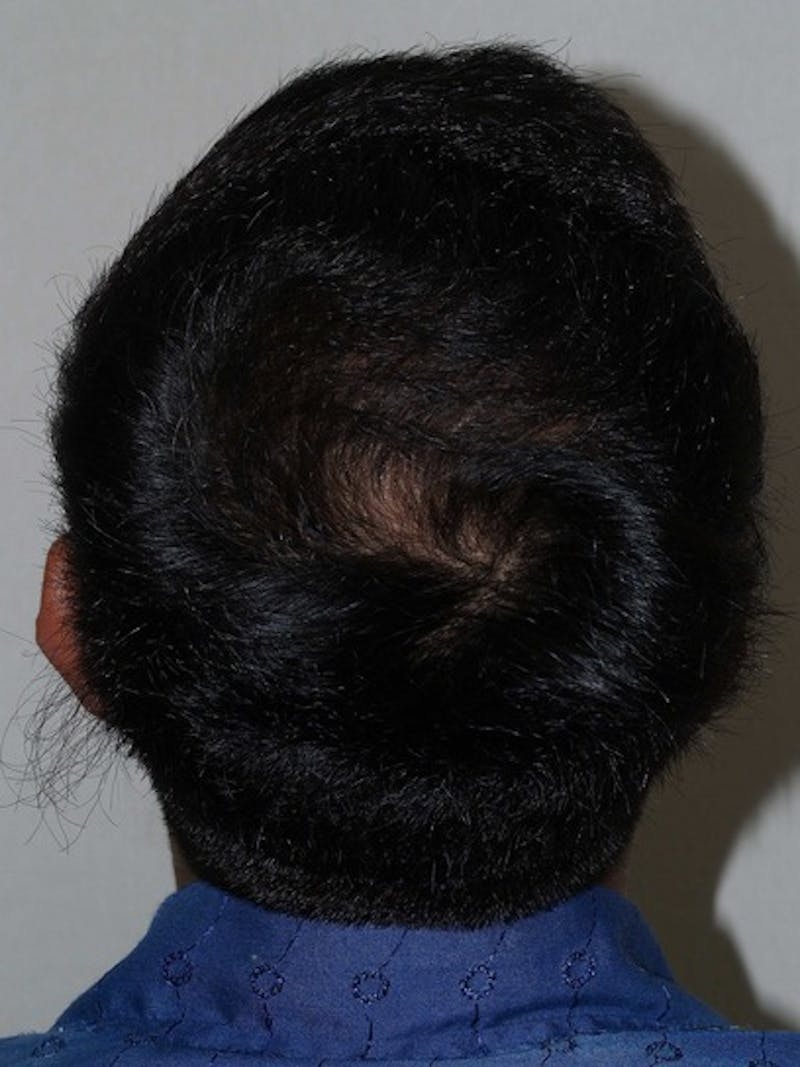 Hair Restoration for Men Before & After Gallery - Patient 404555 - Image 2