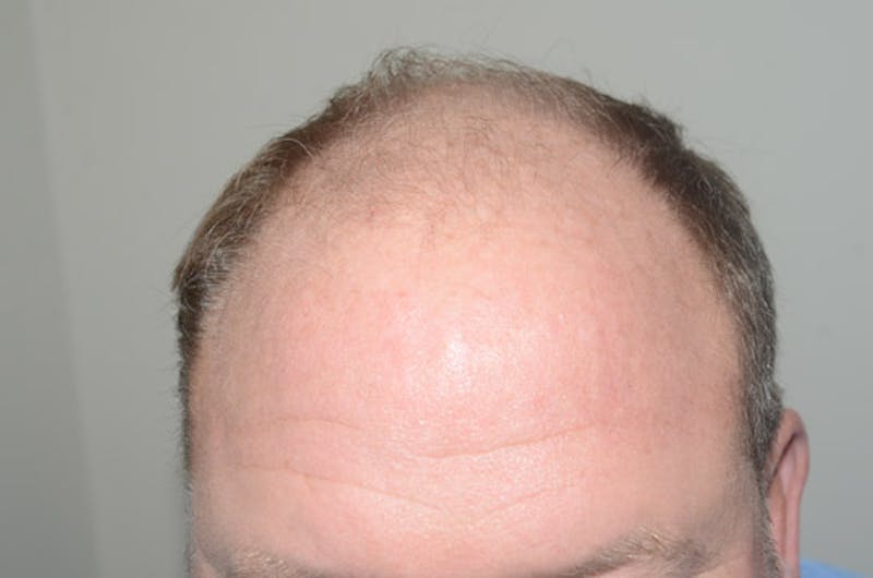 Hair Restoration for Men Before & After Gallery - Patient 257665 - Image 1
