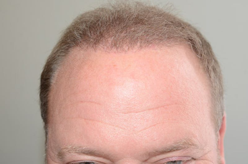 Hair Restoration for Men Before & After Gallery - Patient 257665 - Image 2