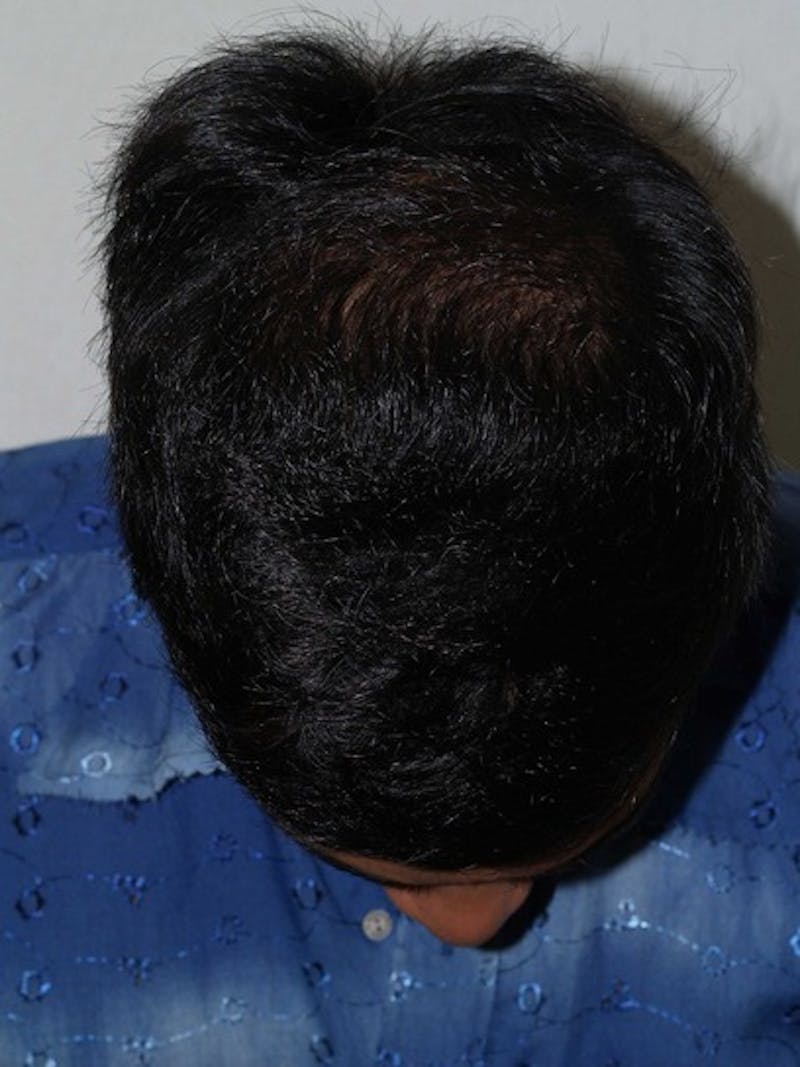 Hair Restoration for Men Before & After Gallery - Patient 404555 - Image 4