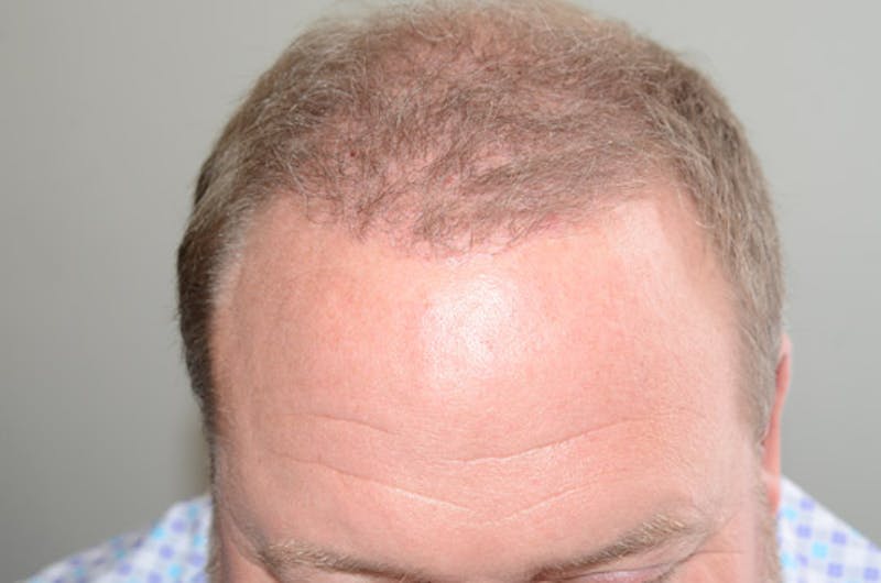 Hair Restoration for Men Before & After Gallery - Patient 257665 - Image 4