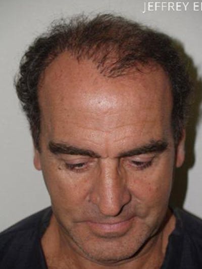 Hair Transplant Repair Before & After Gallery - Patient 428607 - Image 1