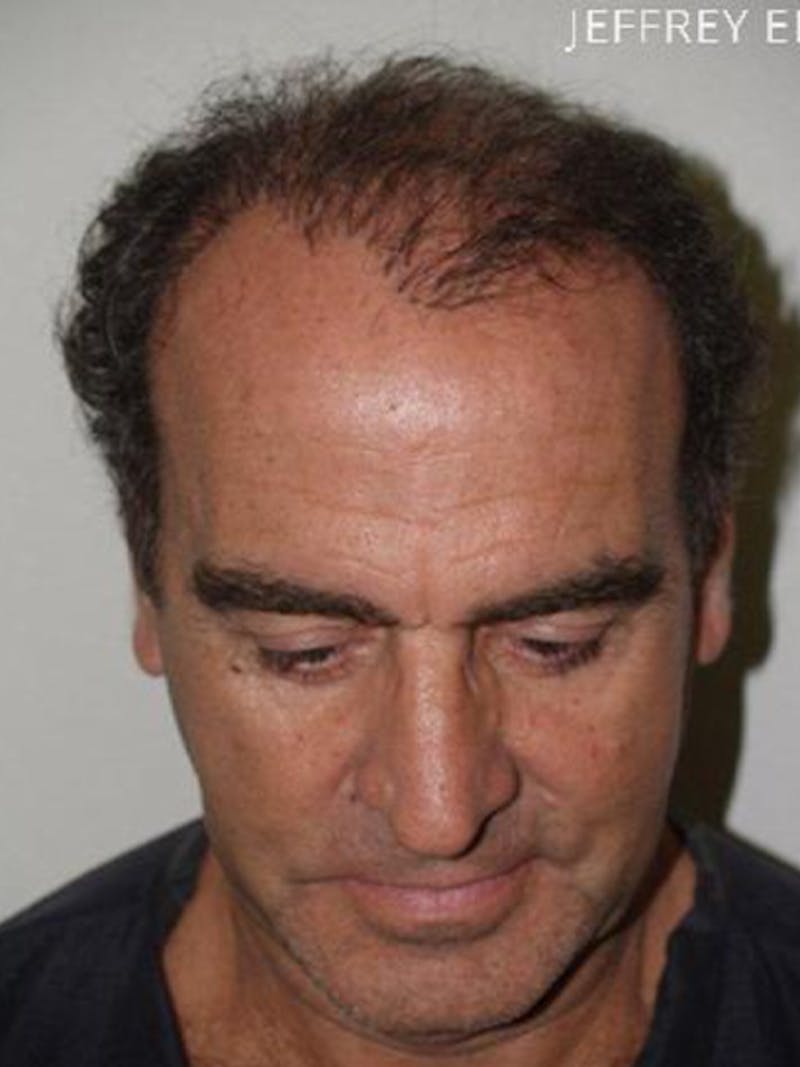 Hair Restoration for Men Before & After Gallery - Patient 181142 - Image 3