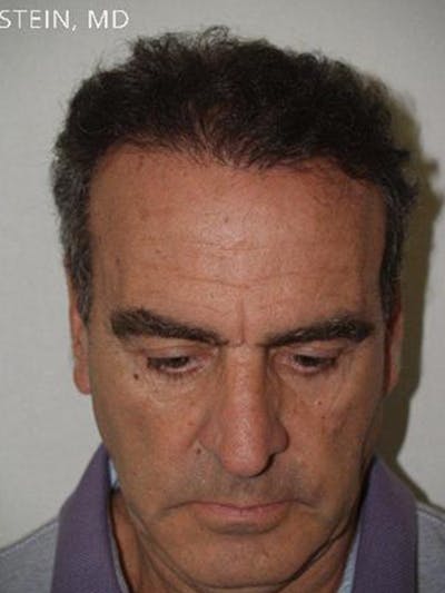 Hair Transplant Repair Before & After Gallery - Patient 428607 - Image 2