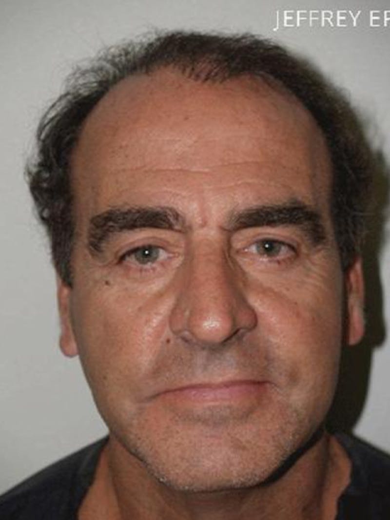 Hair Restoration for Men Before & After Gallery - Patient 181142 - Image 5