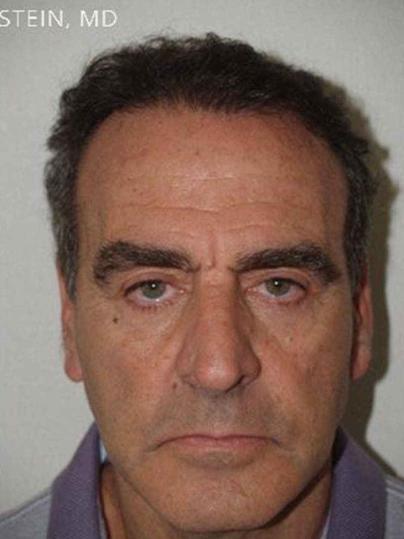 Hair Restoration for Men Before & After Gallery - Patient 181142 - Image 6