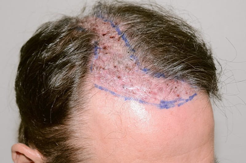 Hair Restoration for Men Before & After Gallery - Patient 335365 - Image 3