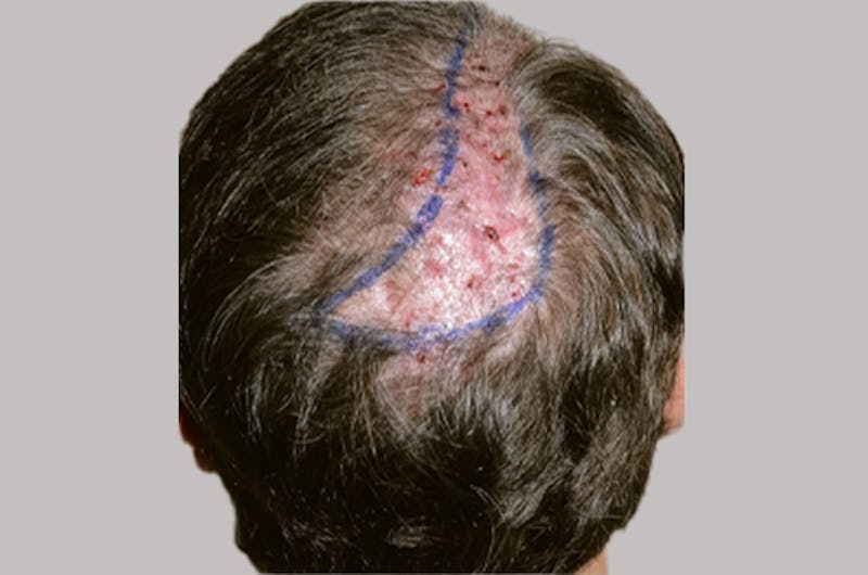 Hair Restoration for Men Before & After Gallery - Patient 335365 - Image 5