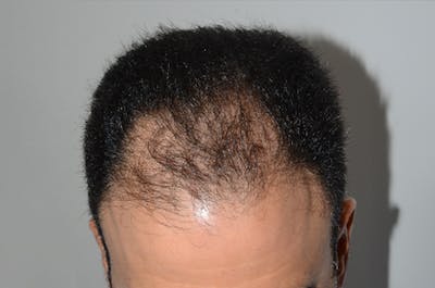 Hair Restoration for Men Before & After Gallery - Patient 353810 - Image 1