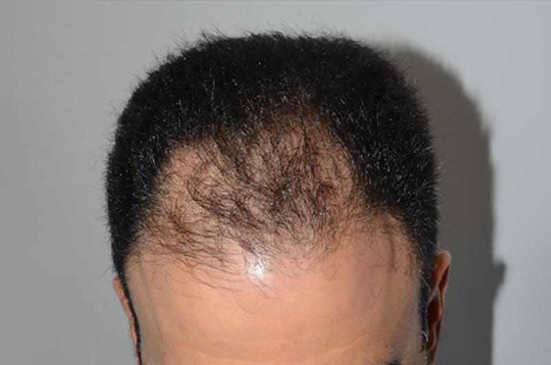 Hair Restoration for Men Before & After Gallery - Patient 203144 - Image 1
