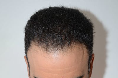 Hair Restoration for Men Before & After Gallery - Patient 353810 - Image 2