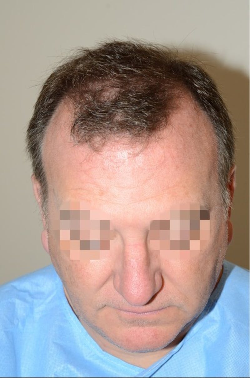 Hair Transplant Repair Before & After Gallery - Patient 835302 - Image 3