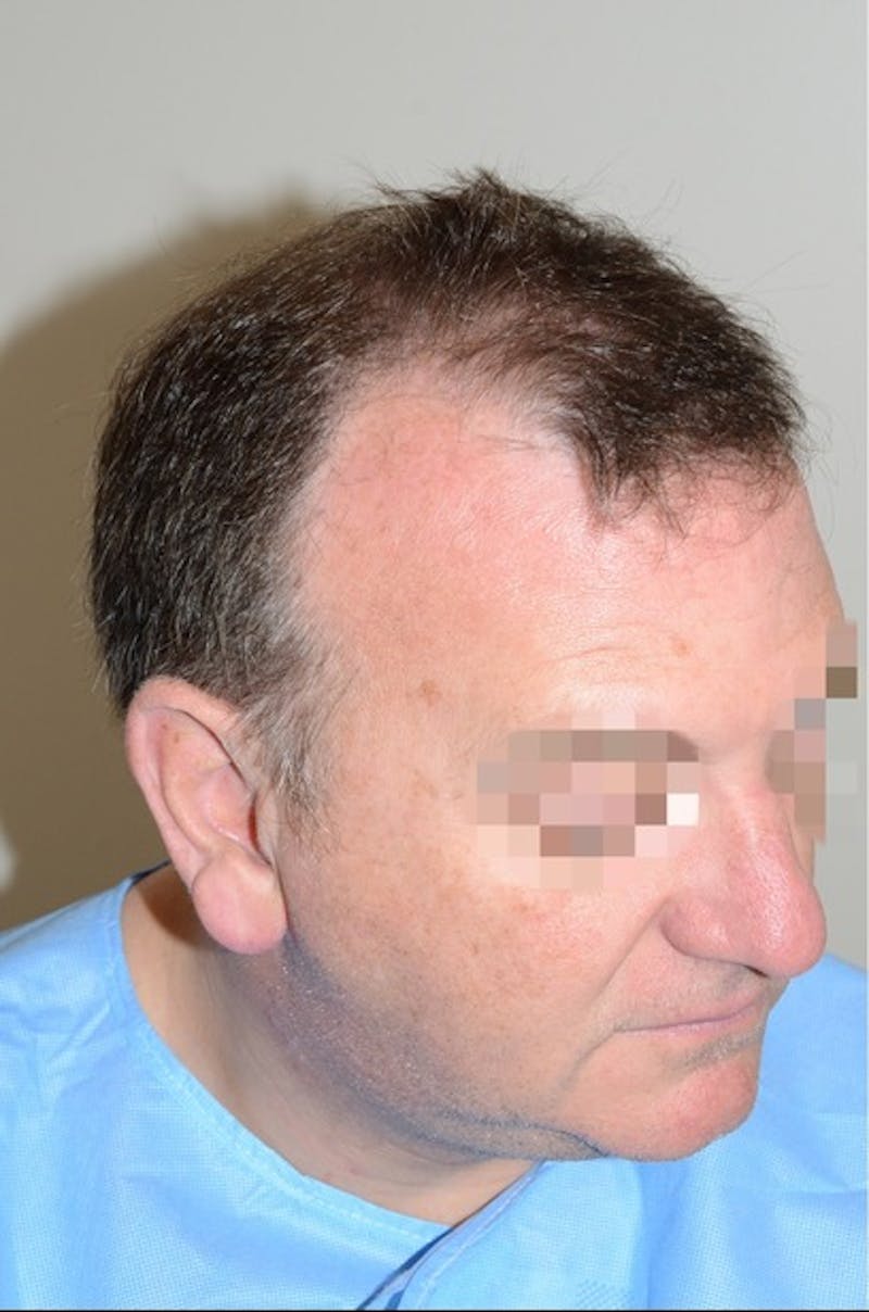 Hair Transplant Repair Before & After Gallery - Patient 835302 - Image 5