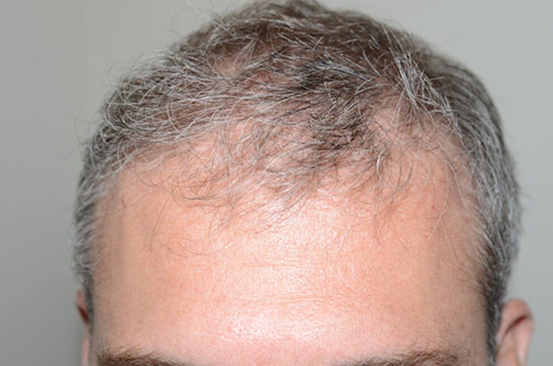 Hair Restoration for Men Before & After Gallery - Patient 338340 - Image 3