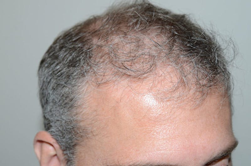 Hair Restoration for Men Before & After Gallery - Patient 338340 - Image 5