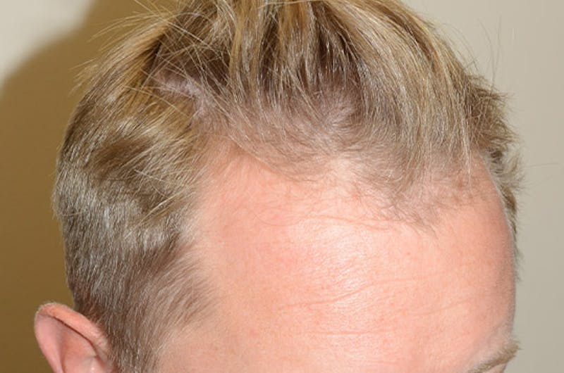 Hair Restoration for Men Before & After Gallery - Patient 399070 - Image 3