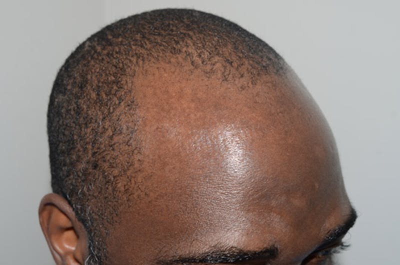 Hair Transplant Repair Before & After Gallery - Patient 160712 - Image 3